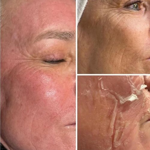 vorher-nacher_algenpeeling_microneedling